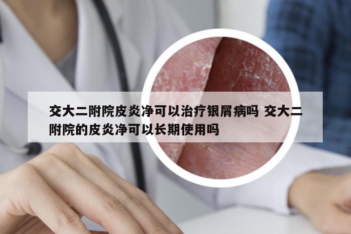 交大二附院皮炎净可以治疗银屑病吗 交大二附院的皮炎净可以长期使用吗