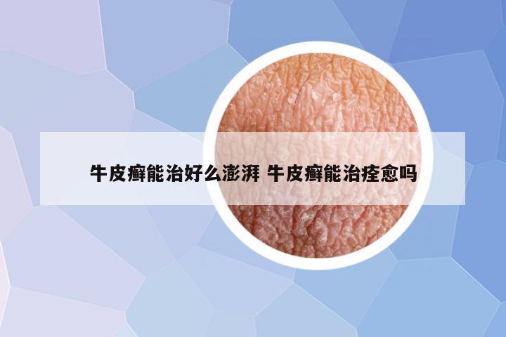 牛皮癣能治好么澎湃 牛皮癣能治痊愈吗
