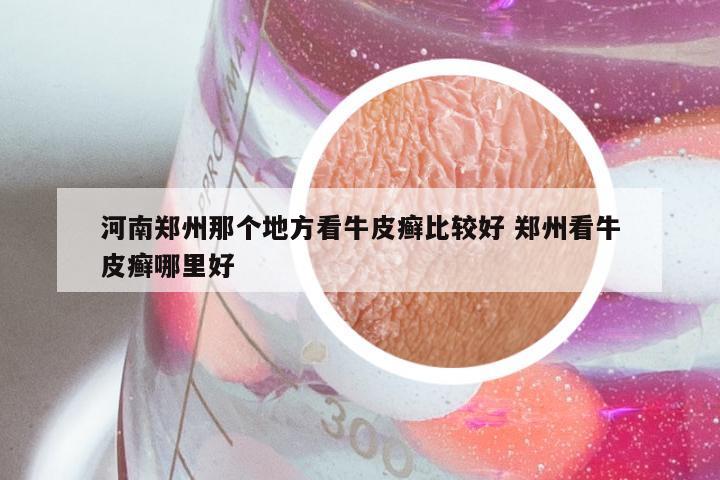 河南郑州那个地方看牛皮癣比较好 郑州看牛皮癣哪里好