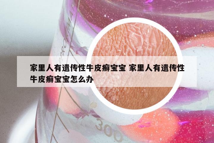 家里人有遗传性牛皮癣宝宝 家里人有遗传性牛皮癣宝宝怎么办