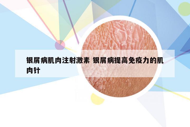 银屑病肌肉注射激素 银屑病提高免疫力的肌肉针
